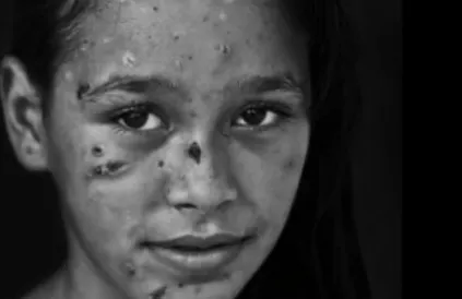 Dalia Khalifa, getroffen door Israëlisch shrapnel (elke wonde bevat een metalen of stenen scherf) tijdens de oorlog van 2014 tegen Gaza. Foto: World Humanitarian Summit 2015/Mohammed Asad Muhaisen